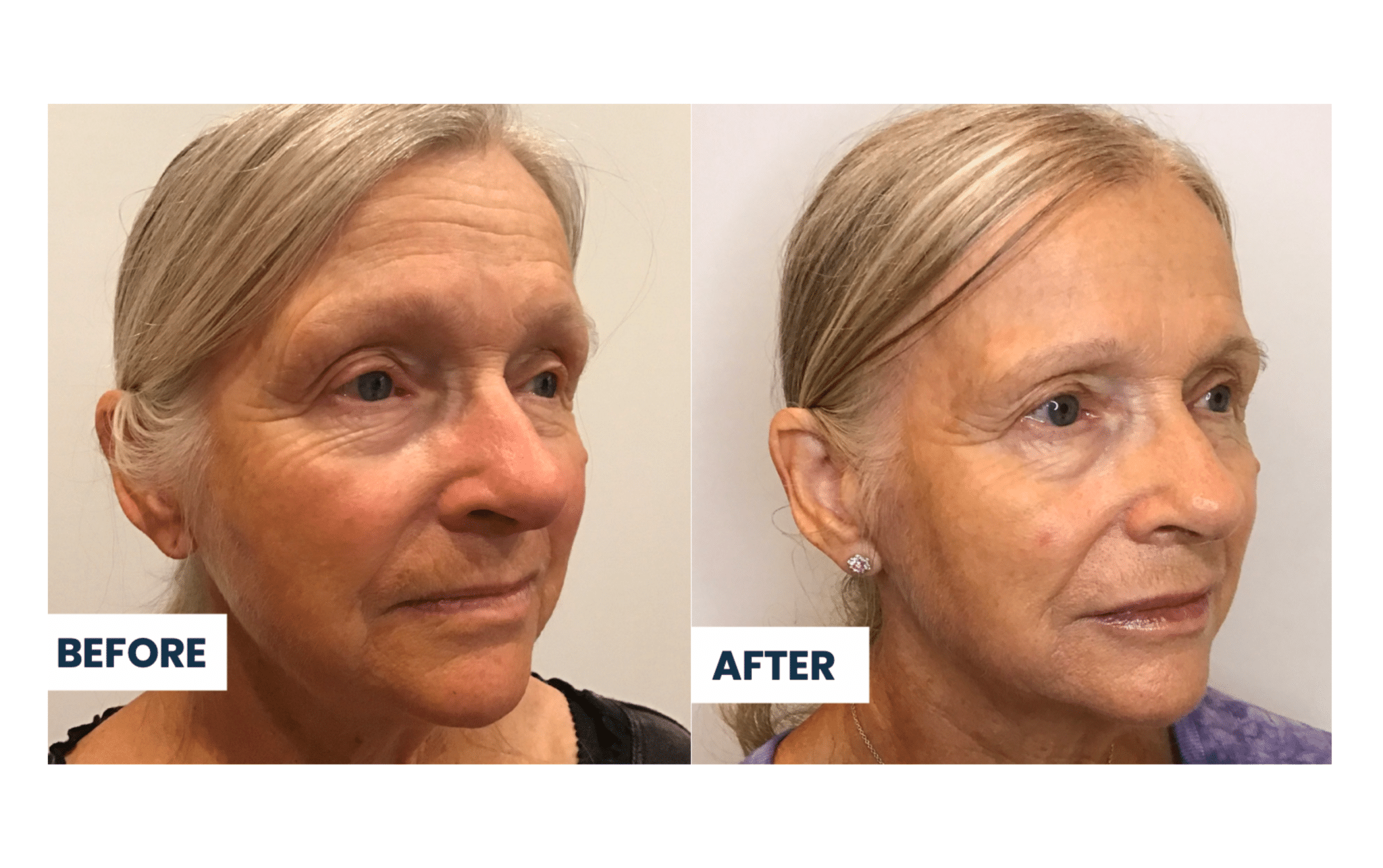 ResurFX Before and After Maggie P.'s Skin Transformation Red